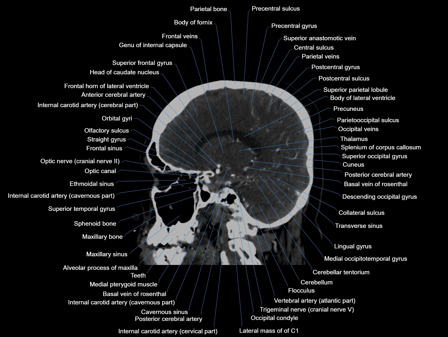 CT scan brain sagittal cross sectional anatomy image-img-00001-00032.webp